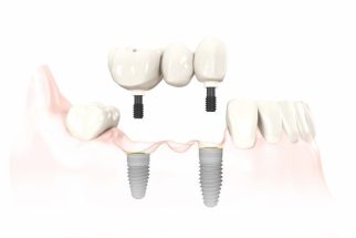 PUENTE IMPLANTES
