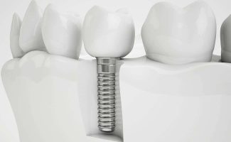 imagen implantes